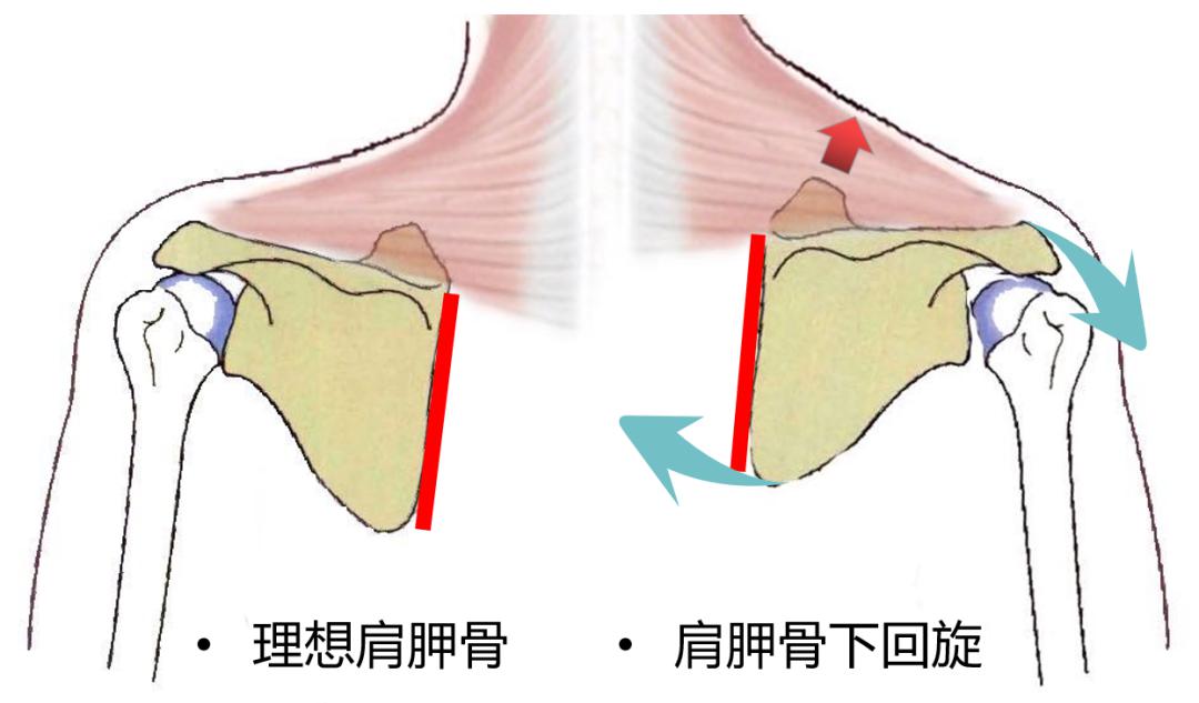 体态大师内端沉肩法斜方肌下降的关键99的人沉错了肩