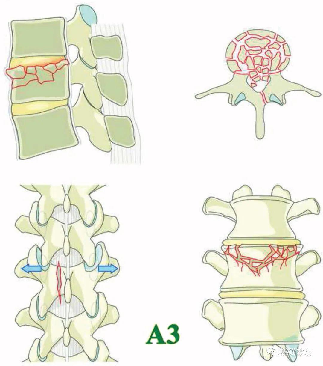 aospine胸腰椎损伤分类系统