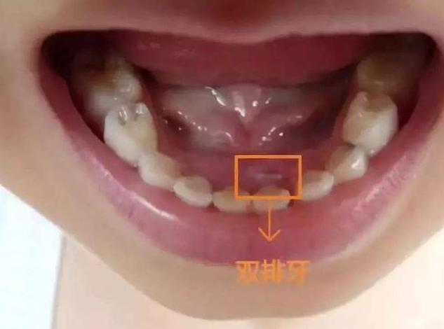 引起双排牙的原因