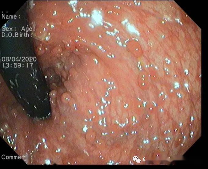 胃肠镜下的"美景"——罕见家族性息肉病_直肠