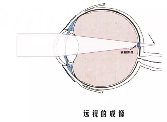 健康|养生专家告诉您,老花眼跟远视眼不是一回事!(90%