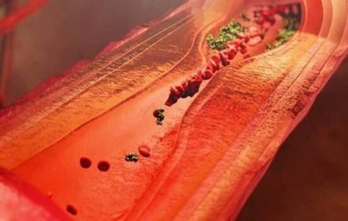 血脂怎么排出 49cebf9ab7fd45a4897bb4a0acc14a68.jpeg