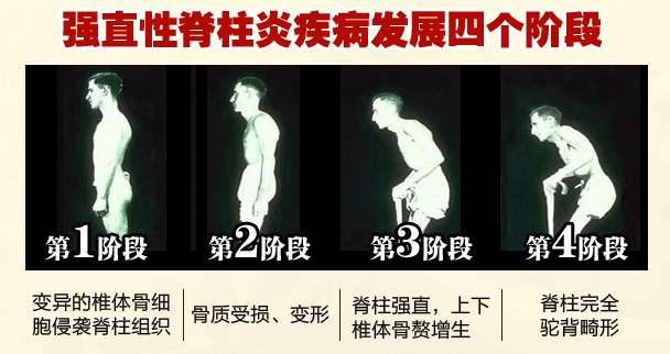 强直性脊柱炎四个发展截断图
