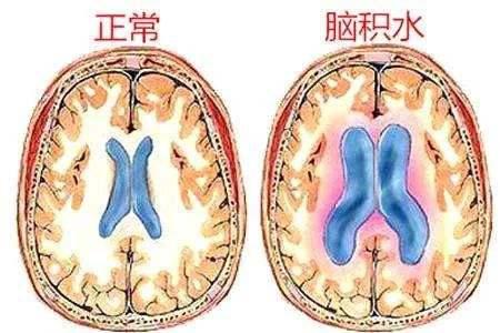 脑子里进水怎么办