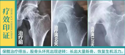 解读:成骨因子技术的原理 股骨头坏死塌陷是因为破骨细胞活动过度,成