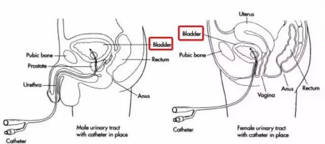 留置尿管到底几天更换一次?见尿为何要再插入?