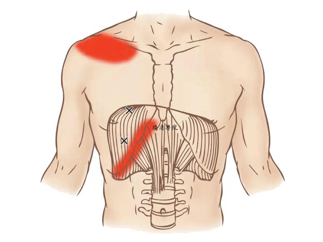 扳机点|膈肌