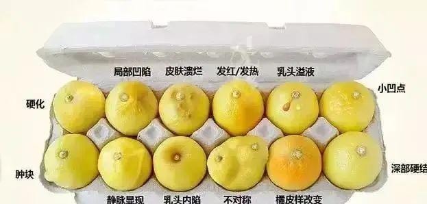 或出现乳房皮肤"酒窝"样凹陷,或有多个皮下小结节是乳腺癌的主要表现