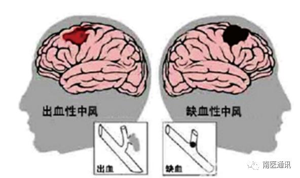 脑梗的症状是什么样的 1963ea25648d40d3873eeb0d9ccfe1e9.jpeg