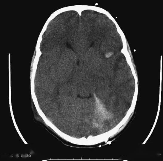 简明又详细的头部ct读片详解,收藏!_脑室