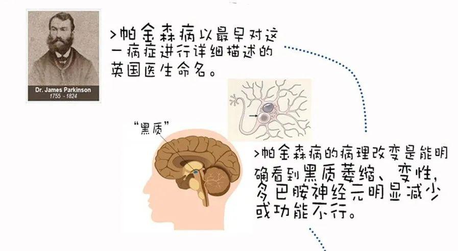 帕金森病的病变部位在人脑的中脑部位,这里有一个叫"黑质"的神经元