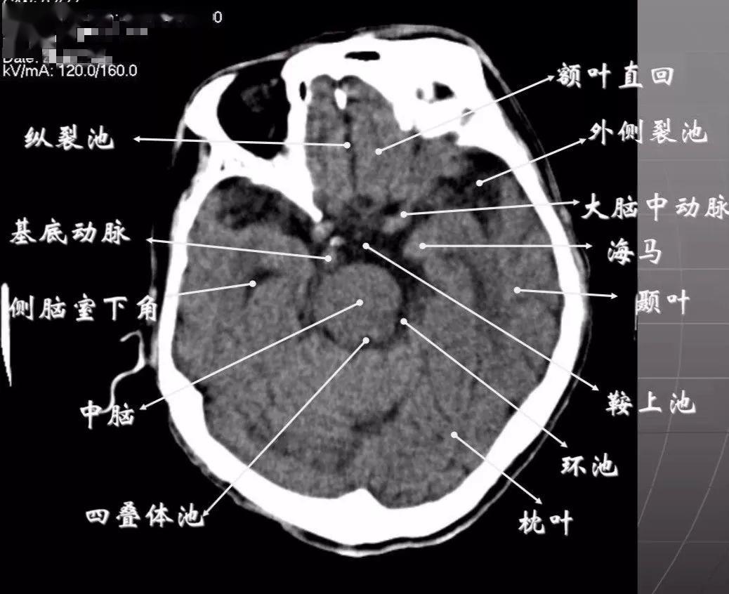 简明又详细的头部ct读片详解,收藏!