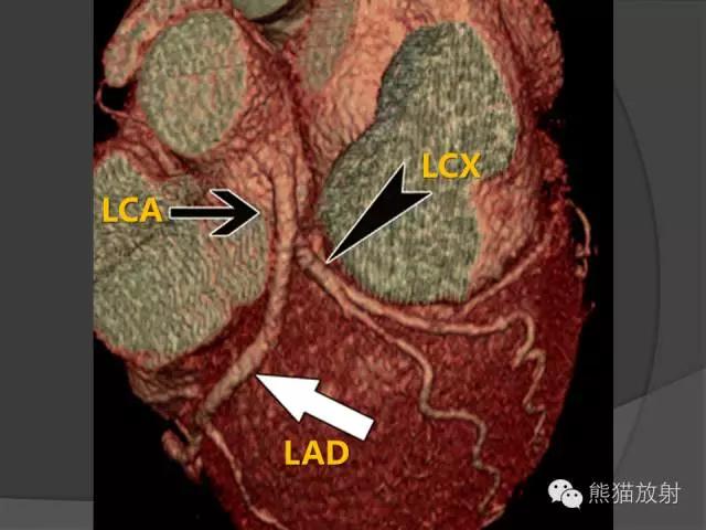 冠状动脉系统解剖,cta解剖,分段及中英文名称对照