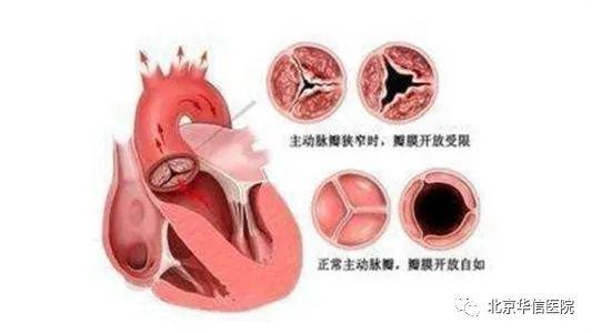 主动脉瓣狭窄的临床表现主要有以下几点