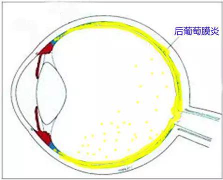 葡萄膜炎是啥?