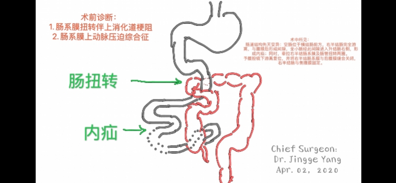 分娩半年后小肠"出轨,28岁年轻妈妈因罕见内疝引发小肠扭转