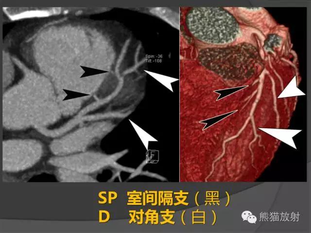 冠状动脉系统解剖,cta解剖,分段及中英文名称对照