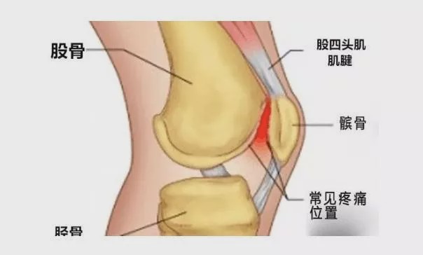 膝盖不同部位疼,可能是什么病?