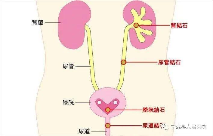 科普带您了解结石治疗愿您石不再来