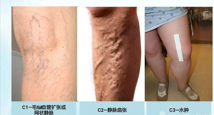 你是蚯蚓腿吗渭南市第二医院微创介入血管外科静脉曲张微创治疗让您