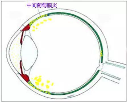 中间葡萄膜炎常见于中青年,炎症的初发部位主要在视网膜脉络膜周边部