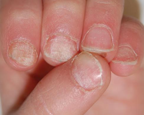 图片所示是典型的甲营养不良,可见指甲表面明显粗糙,相比正常指甲变