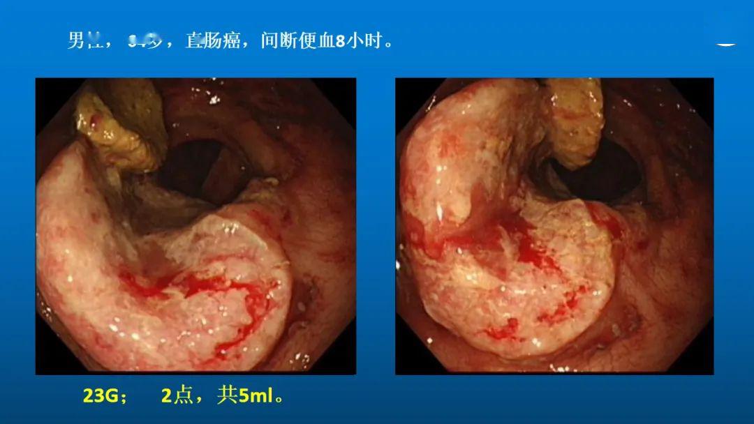 教学ppt消化道晚期恶性肿瘤出血的内镜治疗