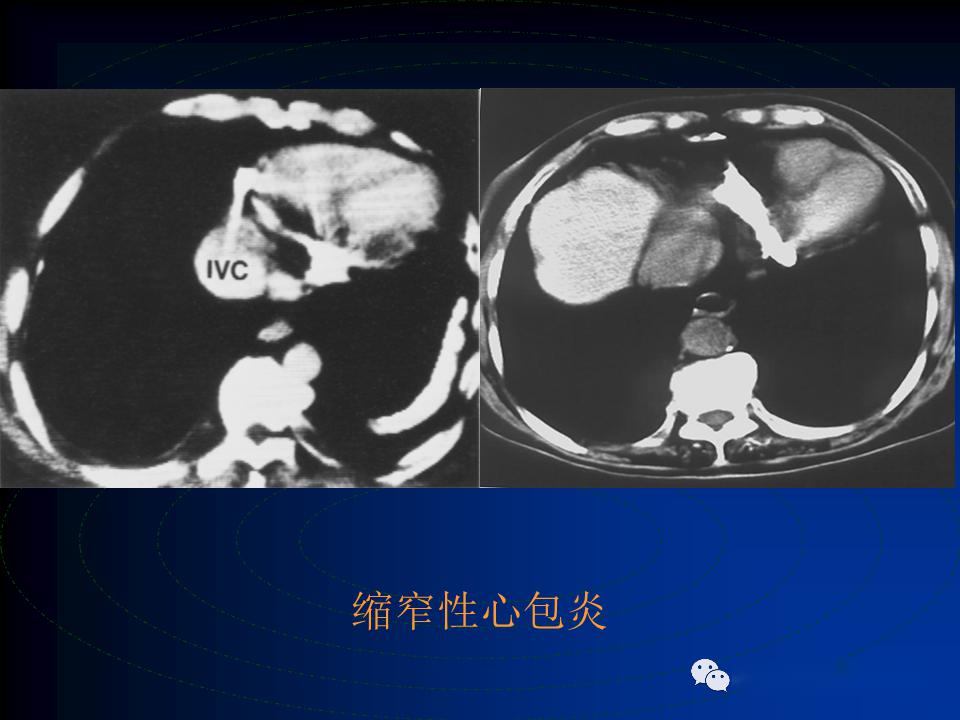 心包疾病的影像学诊断