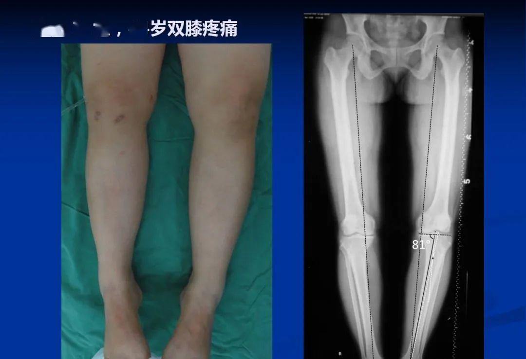 内翻膝骨性关节炎的力学机理和截骨治疗