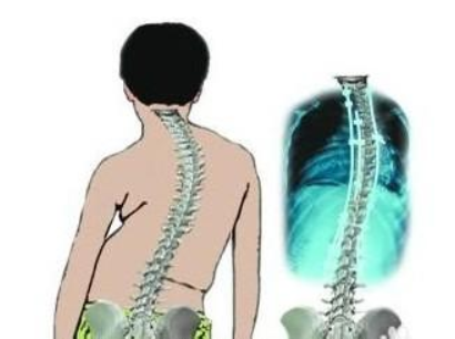 强直性脊柱炎示意图