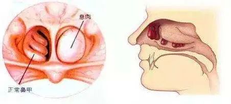 鼻息肉很难治,那是因为大多数患者选择的治疗方法不正确,看看正确的