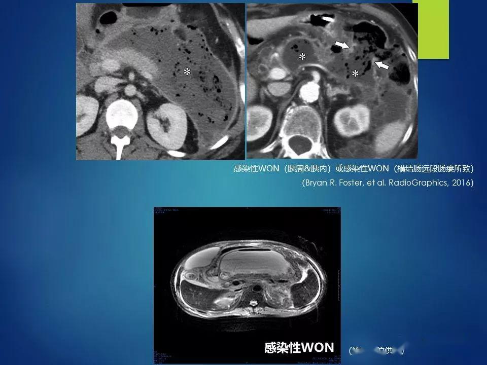 急性胰腺炎,影像科医生需知道什么?