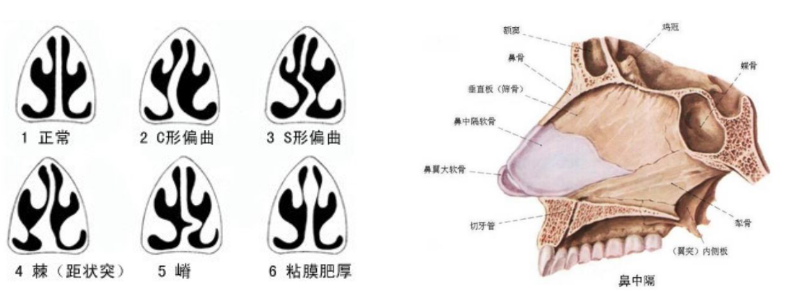 腺样体肥大的患儿长期张口呼吸,日久发生硬腭高拱,鼻腔顶部与底部之间