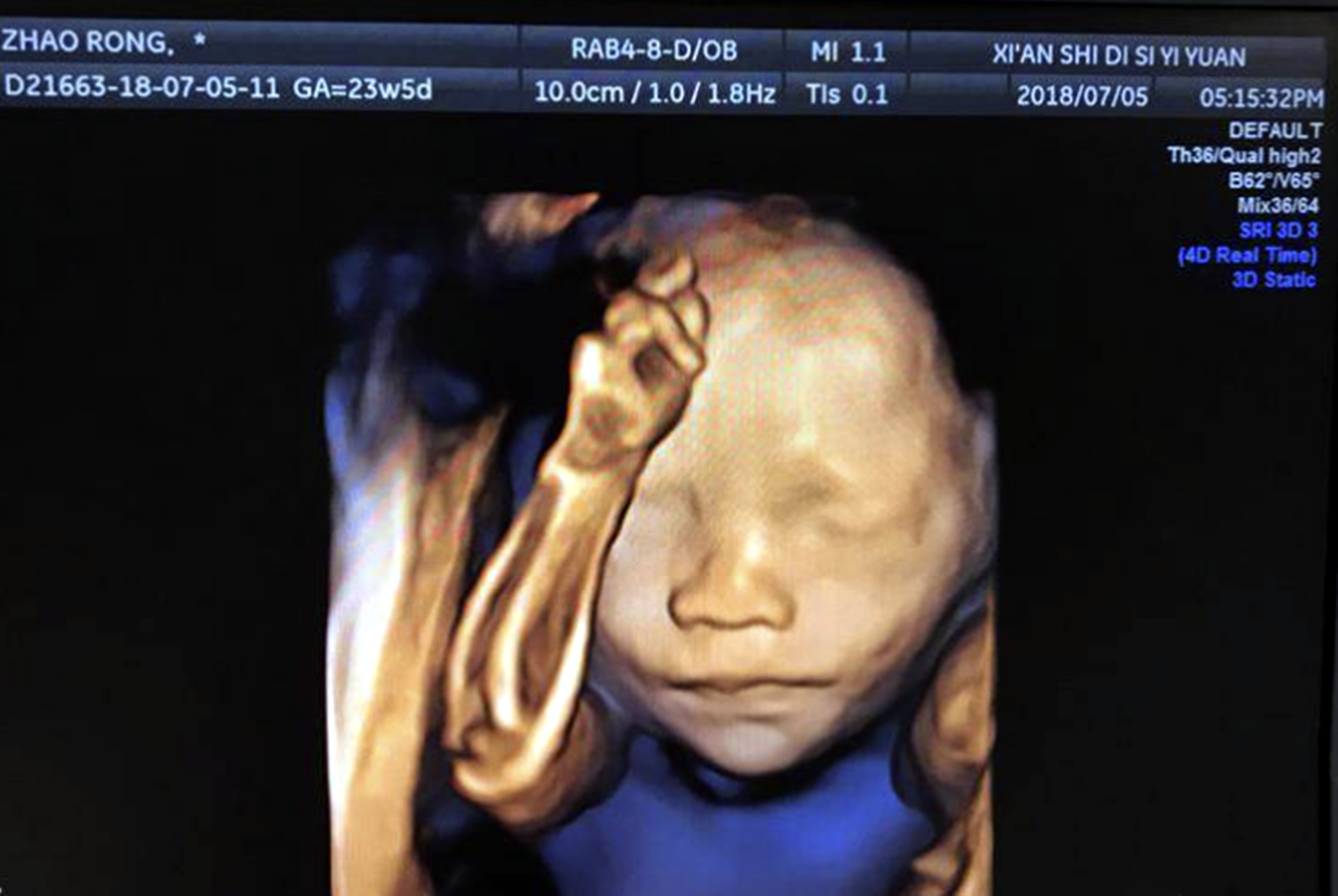 胎儿四维照鼻梁塌陷宝爸质疑妈妈基因伪劣出生后却很惊喜
