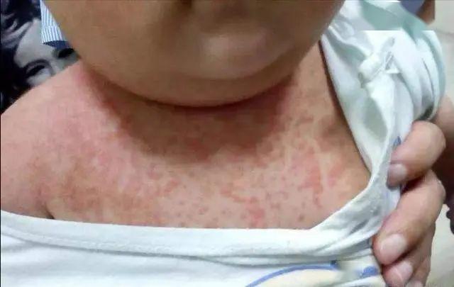 宝宝：幼儿急疹了解一下宝宝第一次发热？家长不用太心急