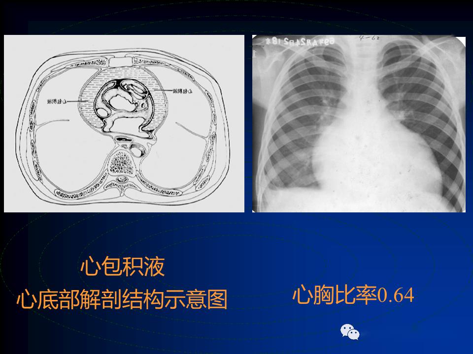 心包疾病的影像学诊断