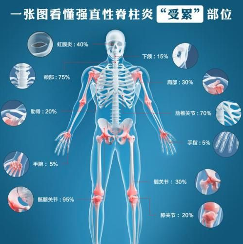 强直性脊柱炎受累部位示意图