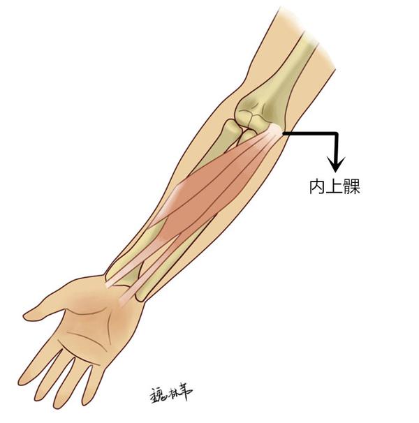 高尔夫球肘又称肱骨内上髁炎,为屈肌总腱处的损伤,前臂屈肌腱起始部