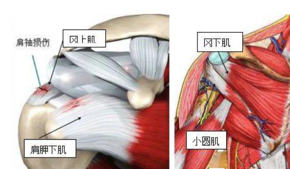 【健康科普】肩痛85%是肩袖损伤,千万不要当肩周炎看!