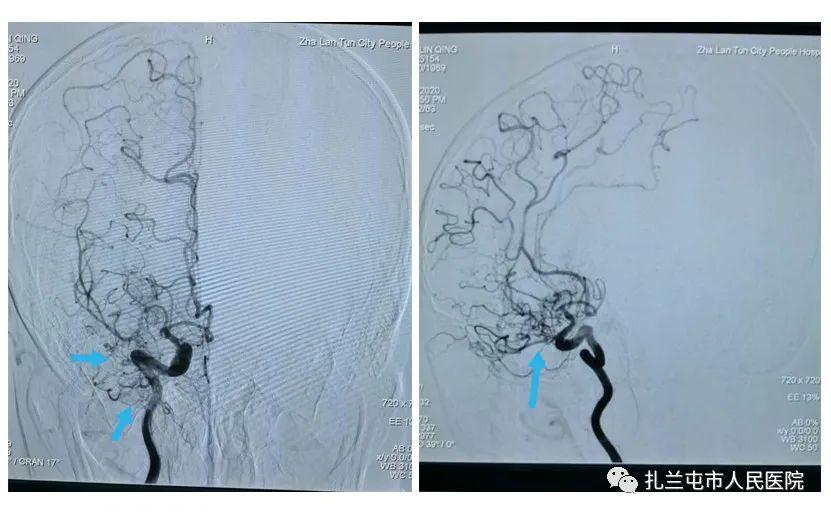 【市人民医院新技术】我院神经外科独立完成全脑血管造影术(dsa)