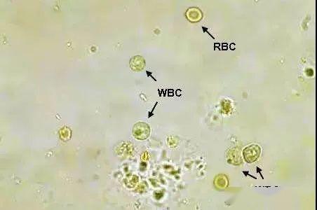 了寄生虫或虫卵,则可以诊断肠道寄生虫感染;出现大量未吸收的脂肪滴