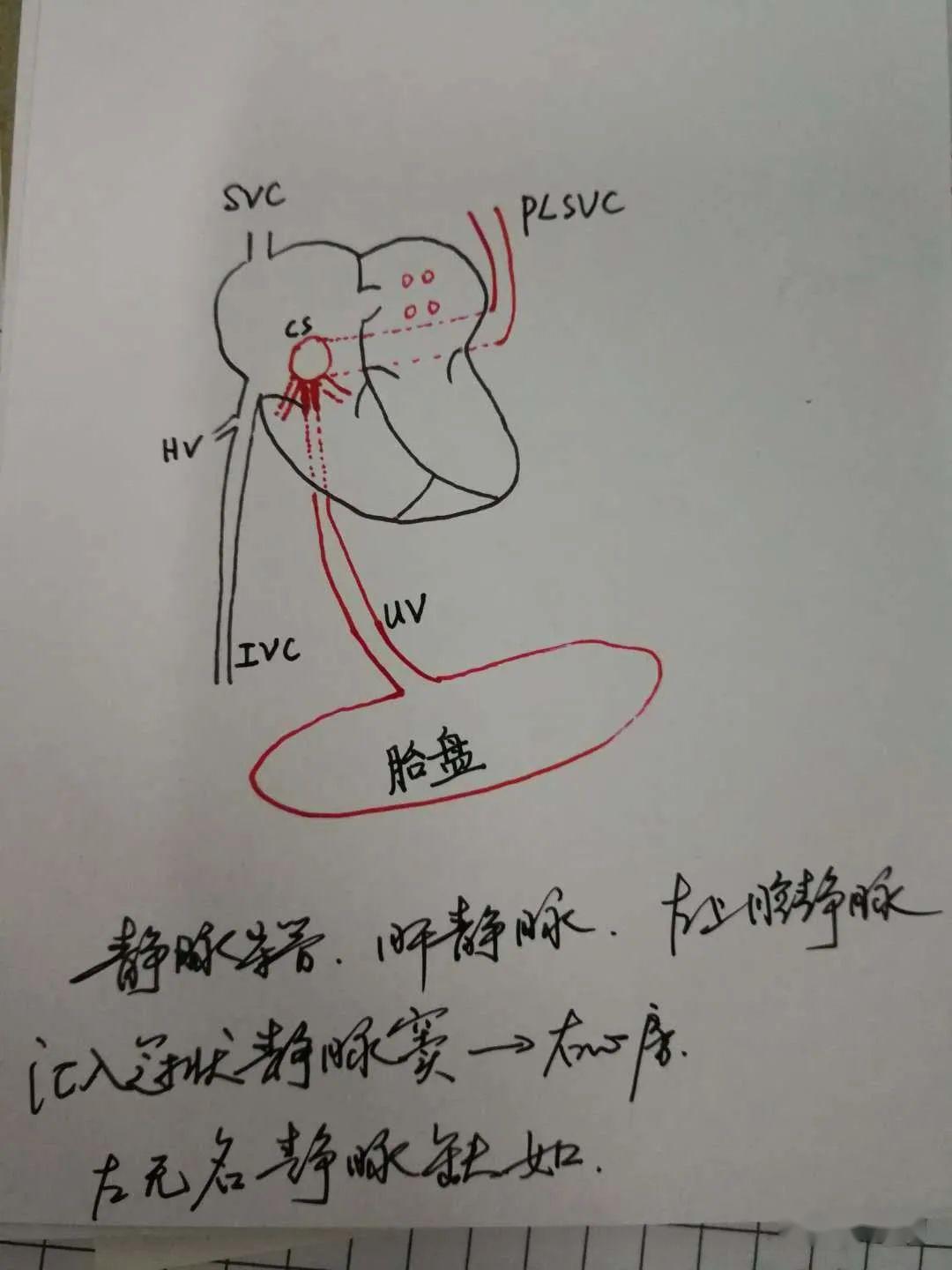 图9 示本病例血流走行的手绘示意图胚胎时期,左脐静脉远心端与肝窦