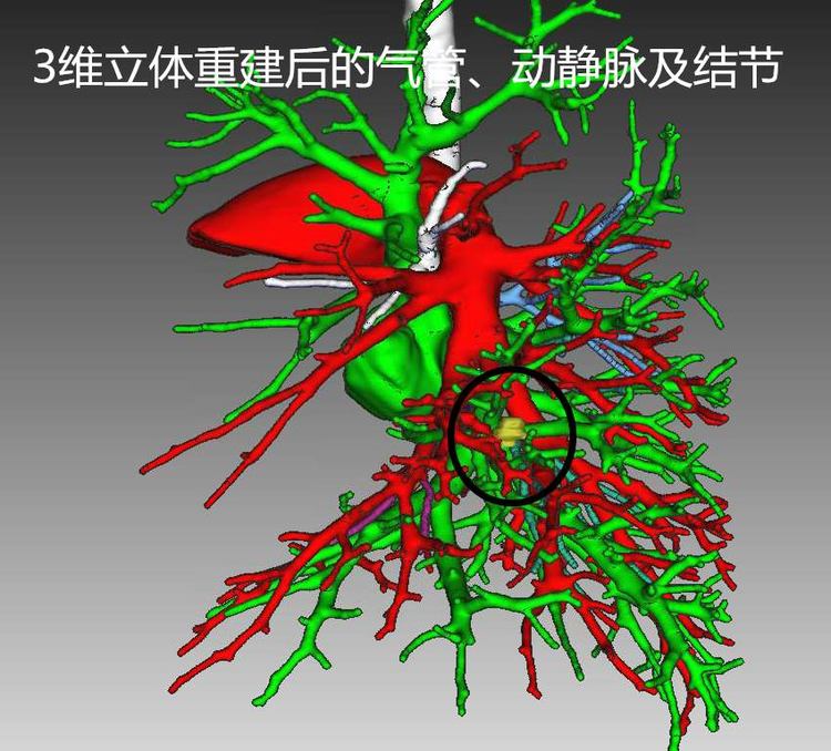 医疗资讯胸腔镜下解剖性肺段切除术