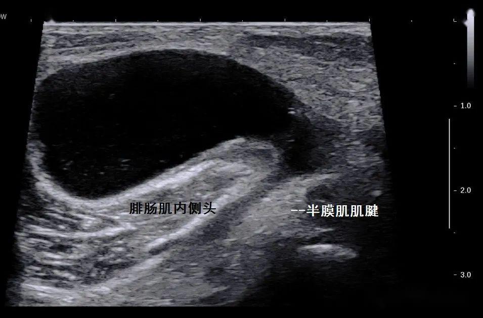 超声征象:"对话框征"