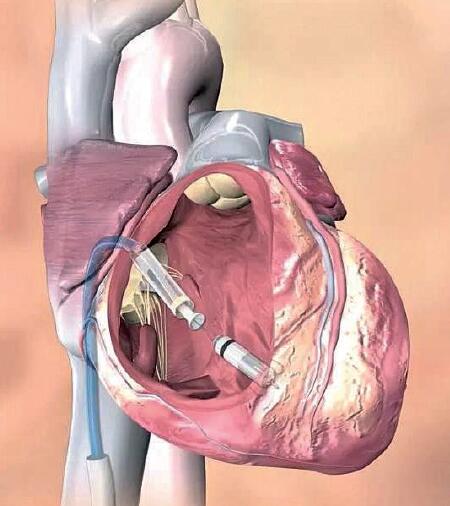 "micra"无导线起搏器心脏安装过程