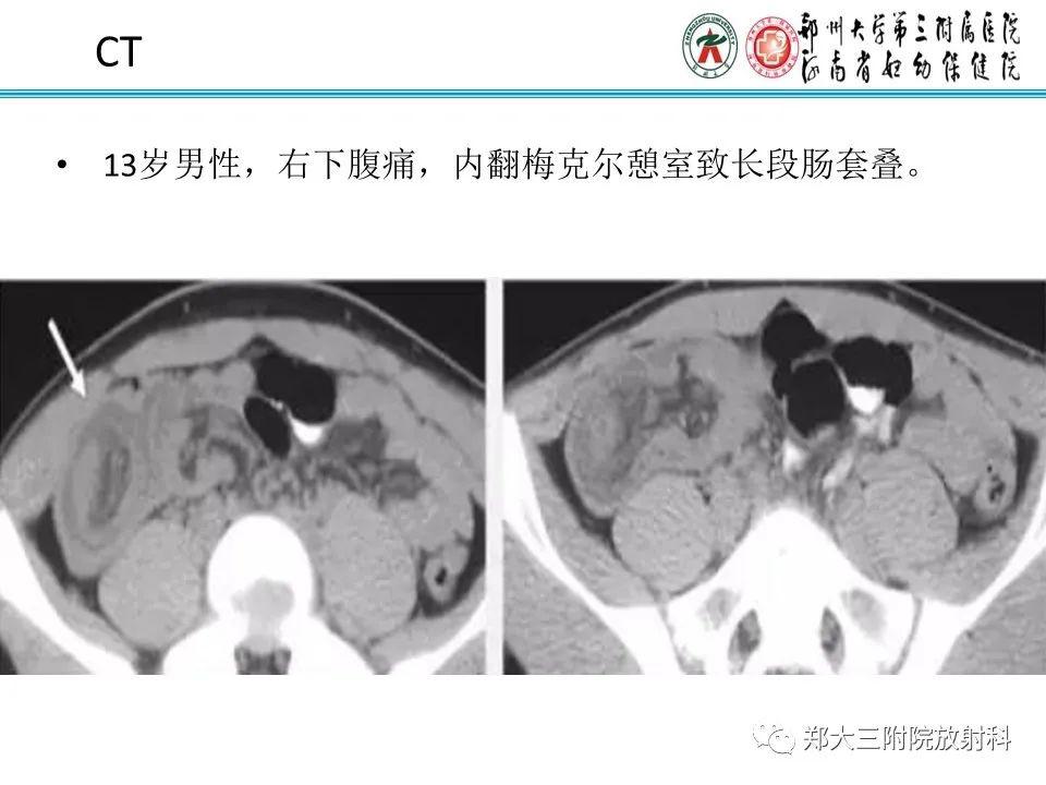 每日一例1052梅克尔憩室影像诊断