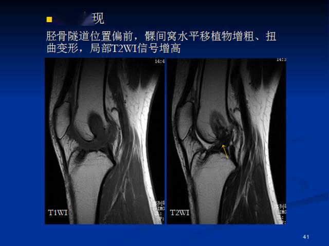 孟悛非教授——半月板和前交叉韧带术后的mri评价