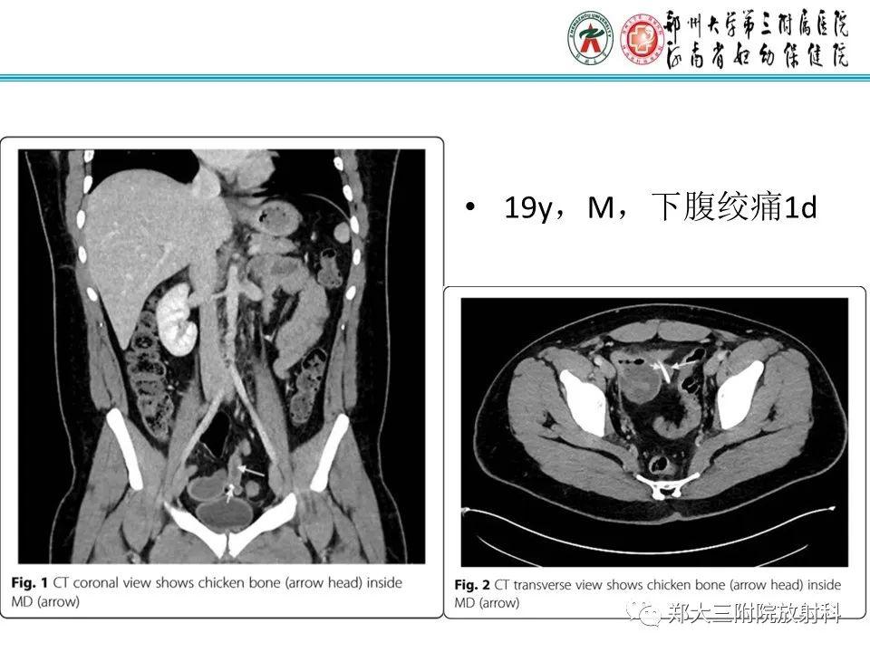 每日一例1052梅克尔憩室影像诊断