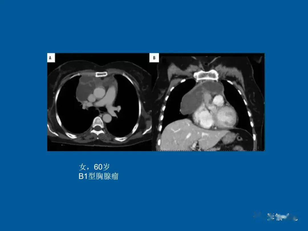 胸腺肿瘤影像诊断