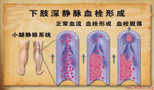 下肢深静脉血栓需要住院治疗吗